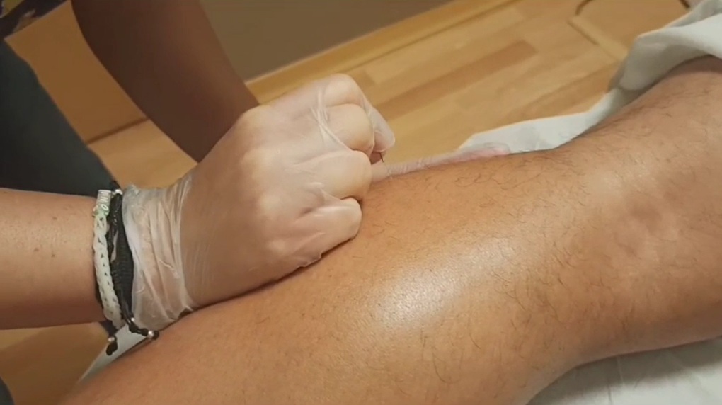 Punción Seca en Ourense EVP FISIOTERAPIA